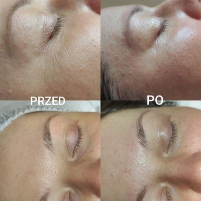 Neolift na zmarszczki salon Od Nowa Jarocin