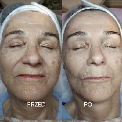 Neolift na zmarszczki salon Od Nowa Jarocin