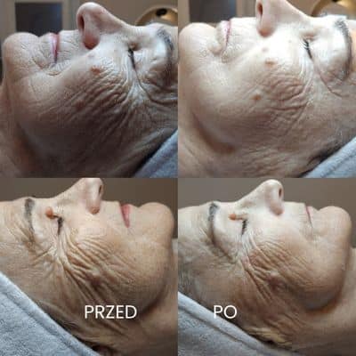 Neolift na zmarszczki salon Od Nowa Jarocin